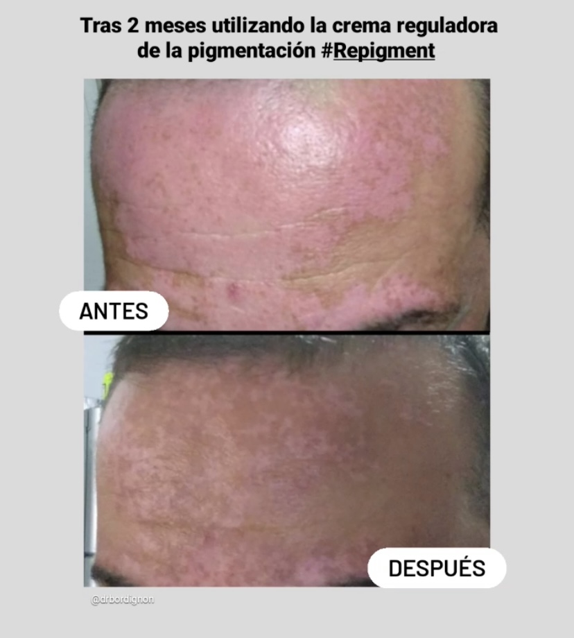 ¿Quieres olvidarte del Vitíligo?