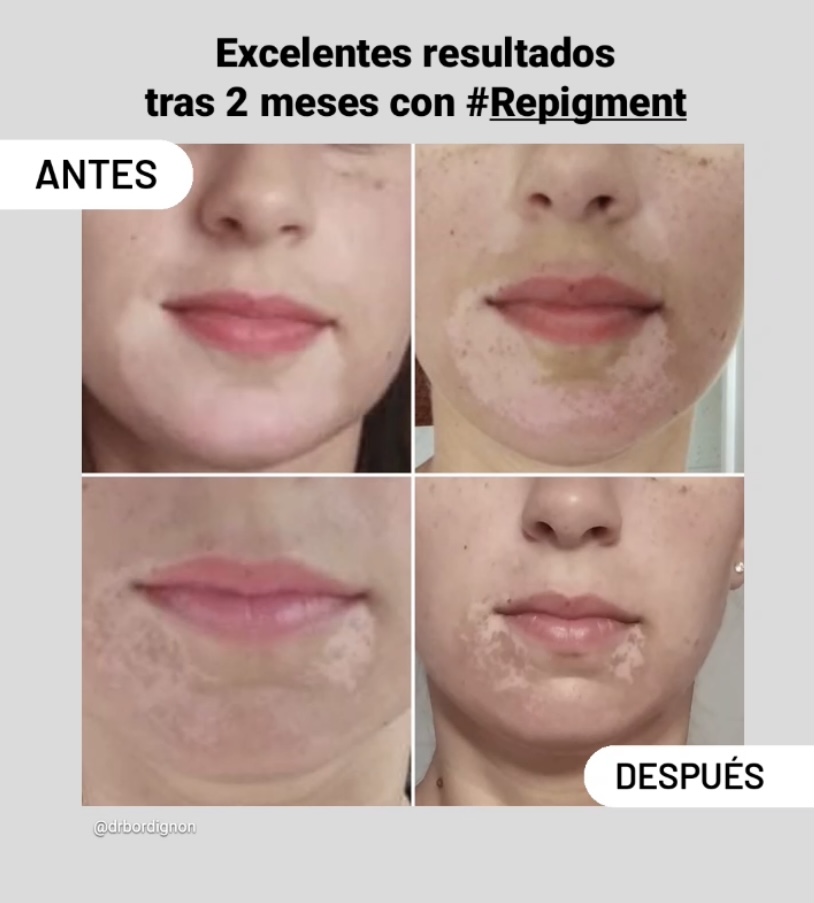 ¿Quieres olvidarte del Vitíligo?